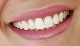 PORCELAIN VENEERS